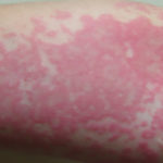 Chronic Idiopathic Urticaria: What You Need To Know