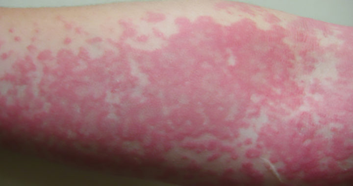 Chronic Idiopathic Urticaria: What You Need To Know