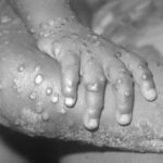 The Origin of Monkeypox