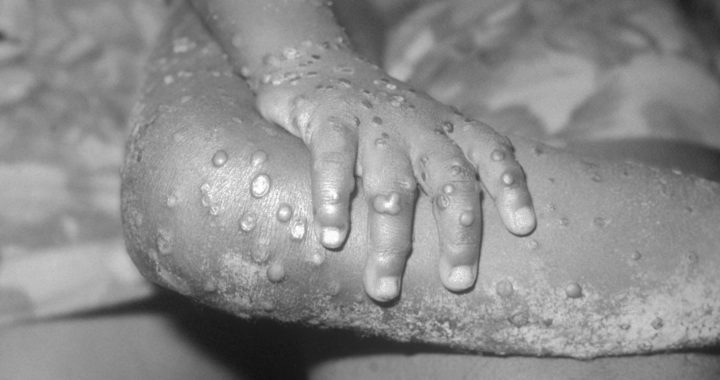 The Origin of Monkeypox